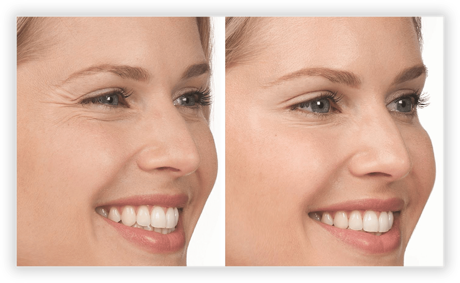 Non Surgical Facelift 2